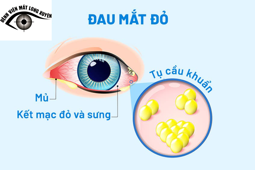 Đau mắt đỏ do vi khuẩn sẽ tiết dịch mủ màu vàng xanh.